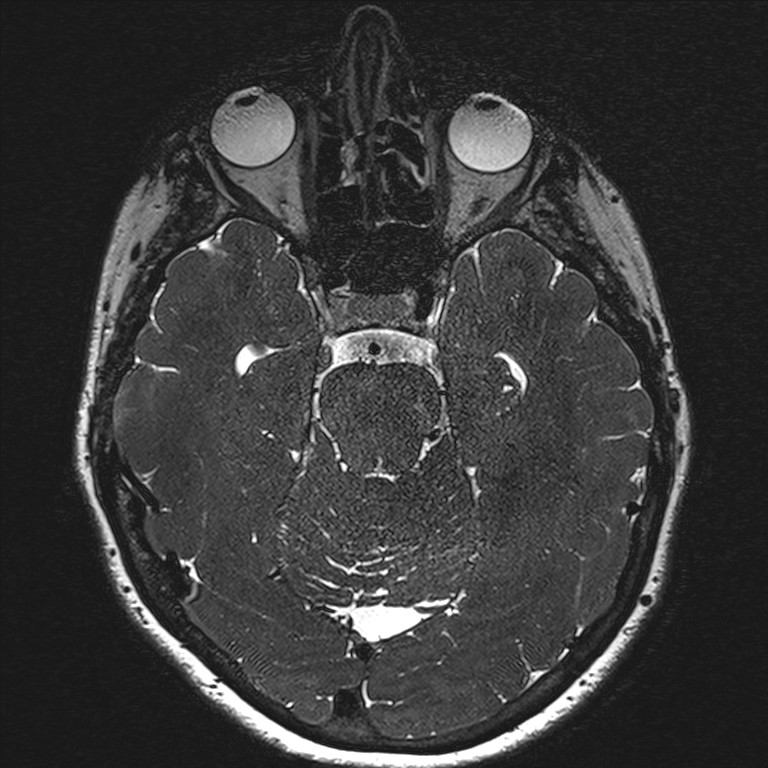 Anterior temporal encephalocele (Radiopaedia 82624-96808 Axial T2 high res 70).jpg