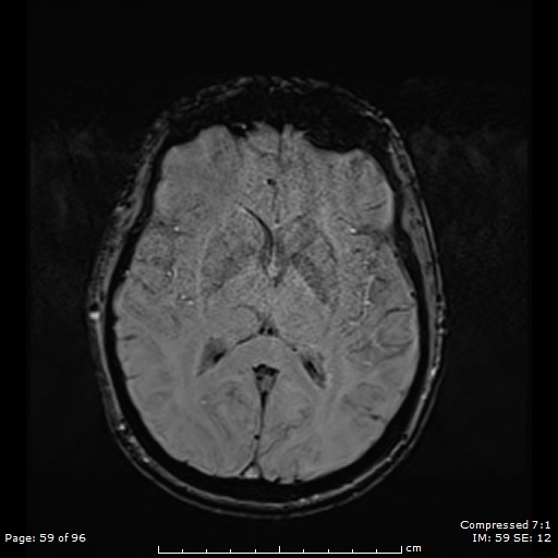 File:Anterior temporal lobe perivascular space (Radiopaedia 88283-104914 Axial SWI 28).jpg