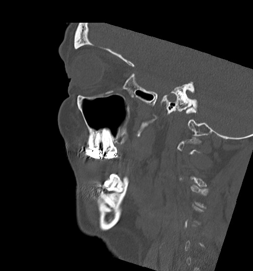 Anterior temporomandibular joint dislocation (Radiopaedia 59430-66784 B 45).jpg