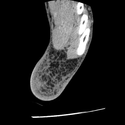 Anterior tibial artery false aneurysm (Radiopaedia 88984-105809 A 242).jpg