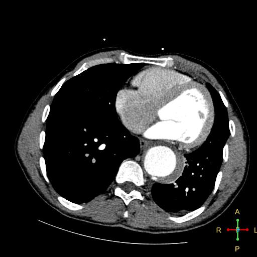 File:Aortic aneurysm and penetrating ulcer (Radiopaedia 23590-23704 A 22).jpg