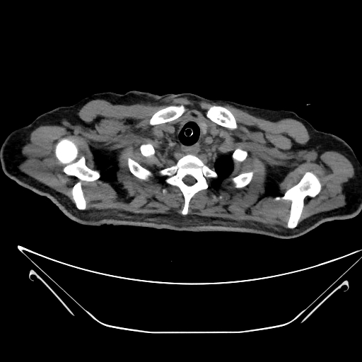 File:Aortic arch aneurysm (Radiopaedia 84109-99365 Axial non-contrast 30).jpg