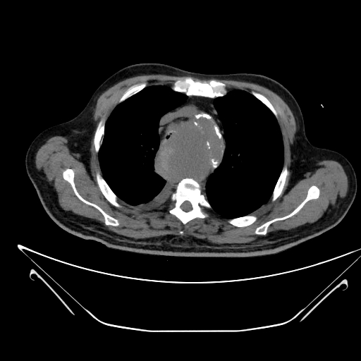 Aortic arch aneurysm (Radiopaedia 84109-99365 Axial non-contrast 85).jpg