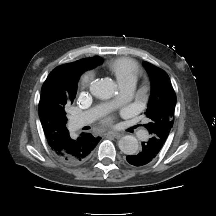 Aortic arch graft infection (FDG PET-CT) (Radiopaedia 71975-82437 A 28).jpg