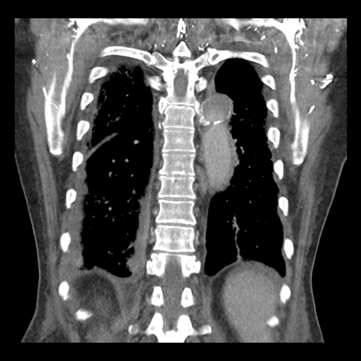 Aortic arch graft infection (FDG PET-CT) (Radiopaedia 71975-82437 Coronal 48).jpg