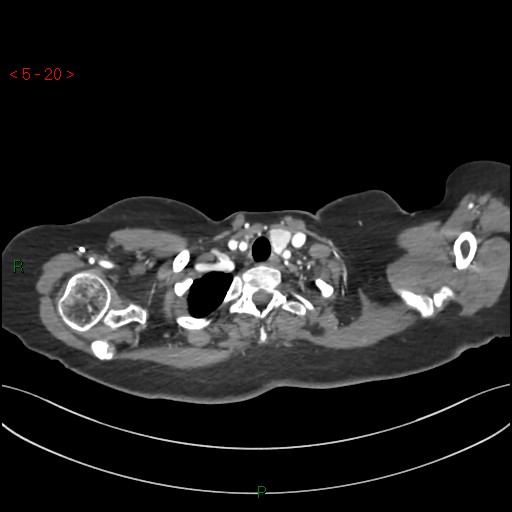 Aortic arch origin of left vertebral artery (Radiopaedia 51520-57286 A 19).jpg