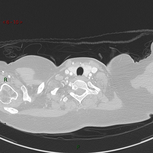 Aortic arch origin of left vertebral artery (Radiopaedia 51520-57286 Axial lung window 10).jpg