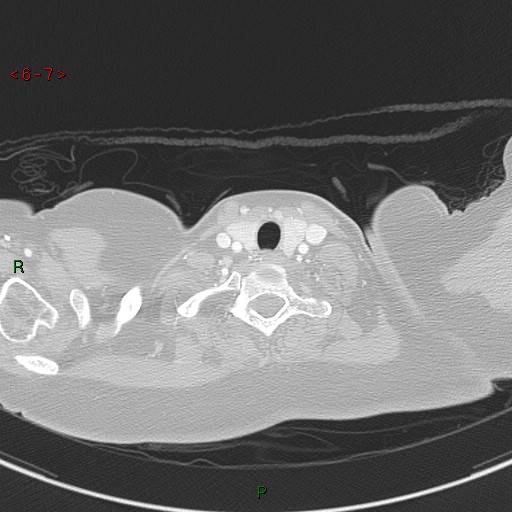 Aortic arch origin of left vertebral artery (Radiopaedia 51520-57286 Axial lung window 7).jpg