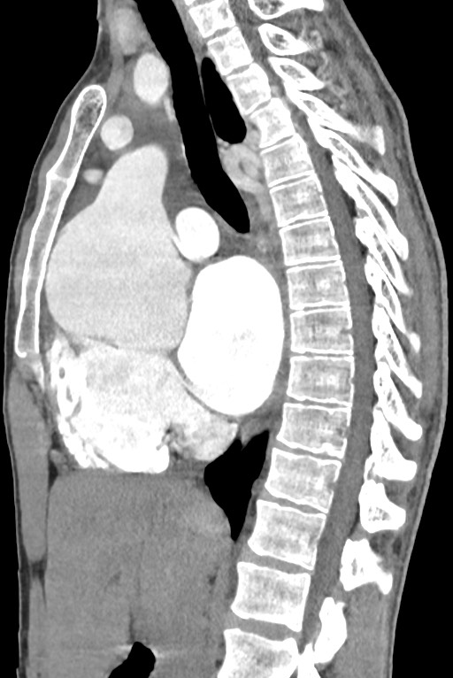 Aortic coarctation with aneurysm (Radiopaedia 74818-85828 B 80).jpg