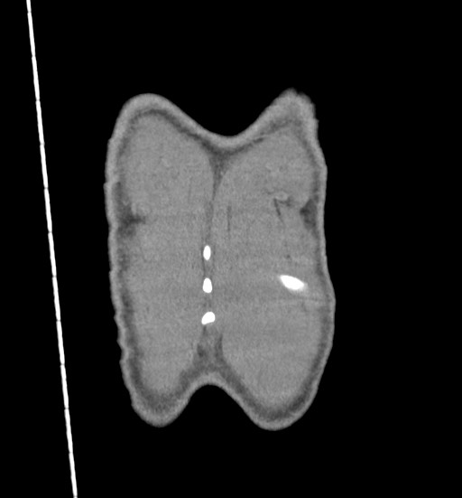 Aortic coarctation with aneurysm (Radiopaedia 74818-85828 C 117).jpg