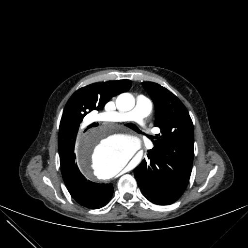 Aortic dissection (Radiopaedia 27466-27665 C+ arterial phase 113).jpg
