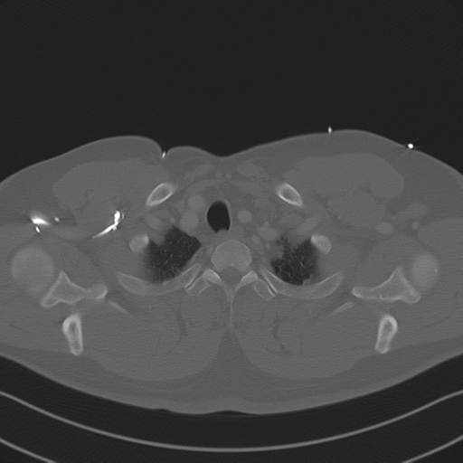 Aortic dissection (Radiopaedia 50763-56234 Axial bone window 16).png
