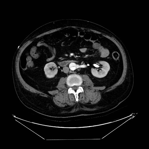 Aortic dissection (Radiopaedia 62562-71000 A 71).jpg