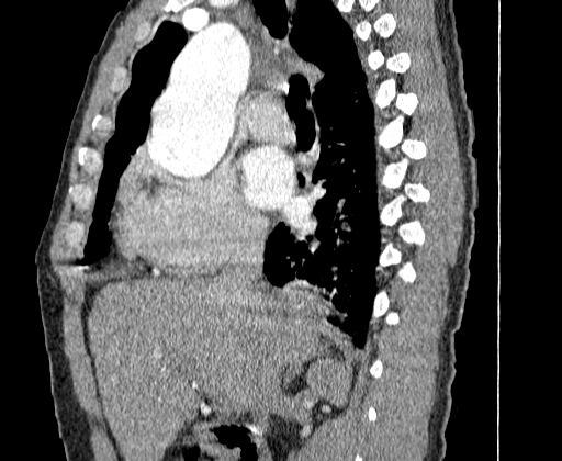 File:Aortic dissection - Stanford A -DeBakey I (Radiopaedia 28339-28587 C 7).jpg
