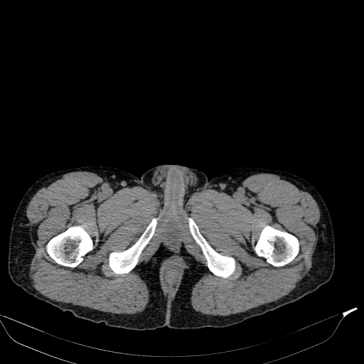 Aortic dissection - Stanford type A (Radiopaedia 83418-98500 Axial non-contrast 98).jpg