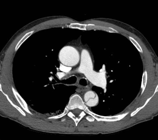 Aortic dissection - Stanford type B (Radiopaedia 73648-84437 A 39).jpg