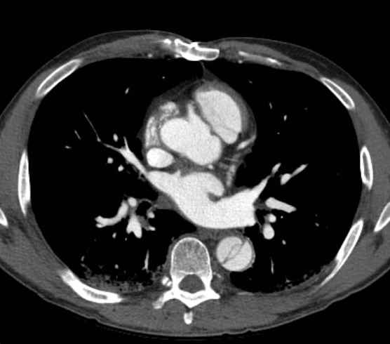 Aortic dissection - Stanford type B (Radiopaedia 73648-84437 A 58).jpg