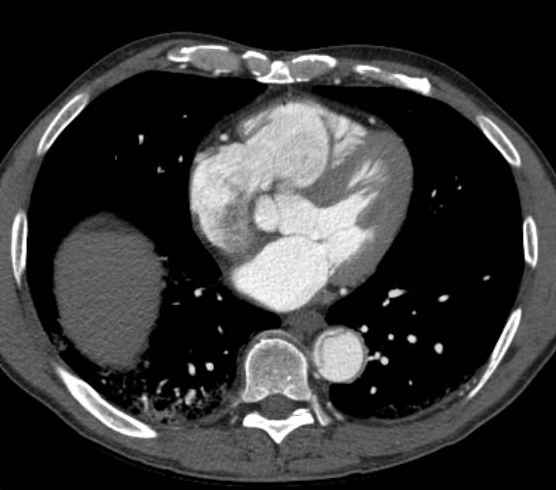 File:Aortic dissection - Stanford type B (Radiopaedia 73648-84437 A 73).jpg