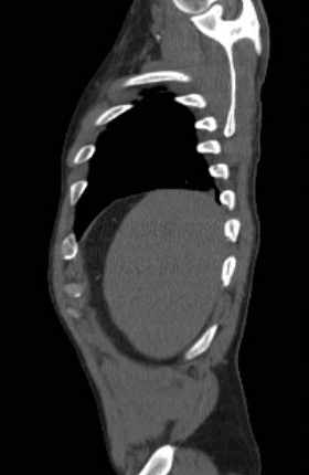 File:Aortic dissection - Stanford type B (Radiopaedia 73648-84437 C 141).jpg