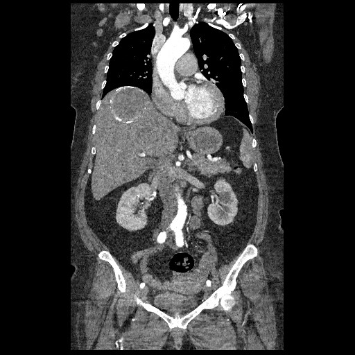File:Aortic dissection - Stanford type B (Radiopaedia 88281-104910 B 29).jpg