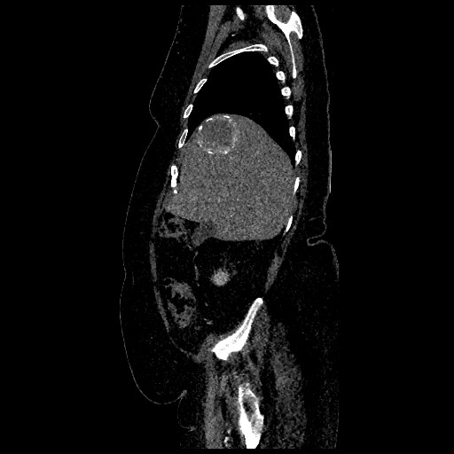 Aortic dissection - Stanford type B (Radiopaedia 88281-104910 C 13).jpg