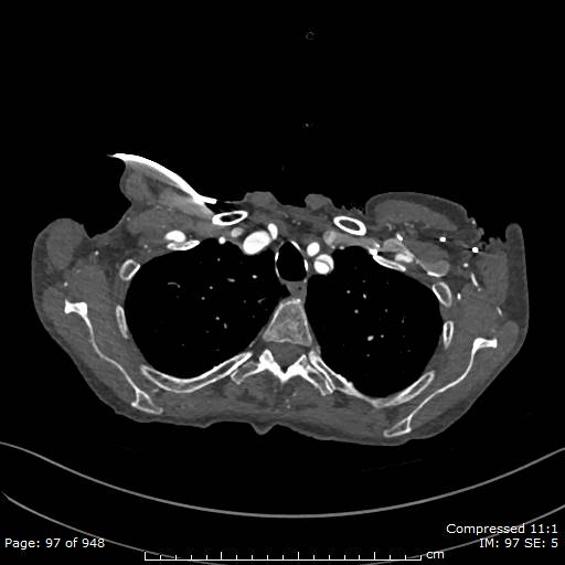 File:Aortic dissection with extension into aortic arch branches (Radiopaedia 64402-73204 B 97).jpg