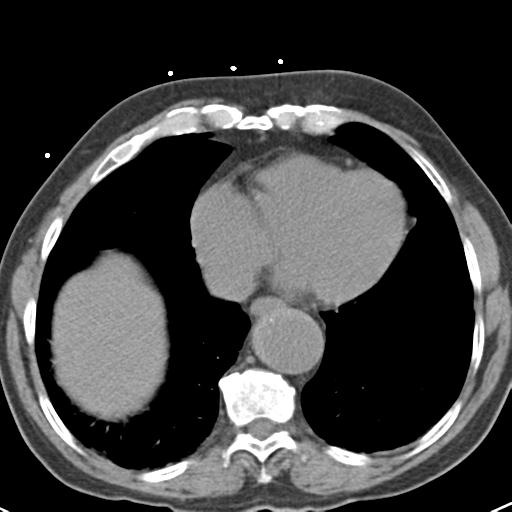 Aortic intramural hematoma (Radiopaedia 31139-31838 Axial non-contrast 39).jpg