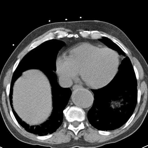 Aortic intramural hematoma (Radiopaedia 31139-31838 Axial non-contrast 40).jpg