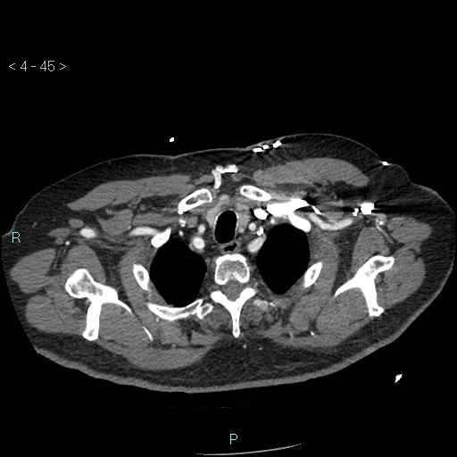 File:Aortic intramural hematoma (Radiopaedia 48463-53380 B 21).jpg