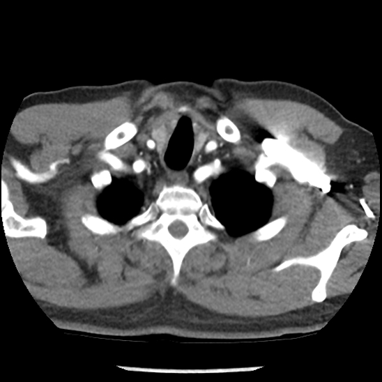 Aortic intramural hematoma (type B) (Radiopaedia 79323-92387 B 2).jpg