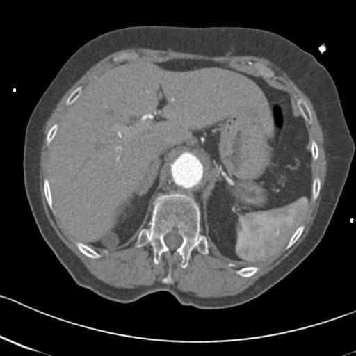 File:Aortic intramural hematoma from penetrating atherosclerotic ulcer (Radiopaedia 31137-31836 A 79).jpg