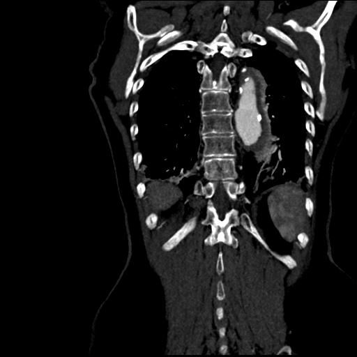 Aortic intramural hematoma from penetrating atherosclerotic ulcer (Radiopaedia 31137-31836 C 56).jpg