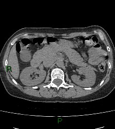 Aortic valve endocarditis (Radiopaedia 87209-103485 Axial non-contrast 106).jpg