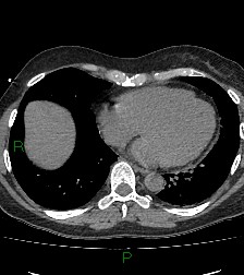 File:Aortic valve endocarditis (Radiopaedia 87209-103485 Axial non-contrast 69).jpg