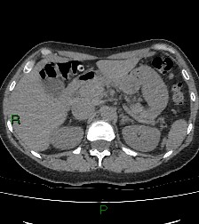 Aortic valve endocarditis (Radiopaedia 87209-103485 Axial non-contrast 99).jpg