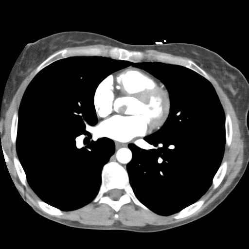 Aortic valve non-coronary cusp thrombus (Radiopaedia 55661-62189 B 29).png