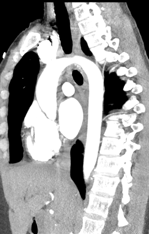Aortic valve non-coronary cusp thrombus (Radiopaedia 55661-62189 C+ arterial phase 31).png