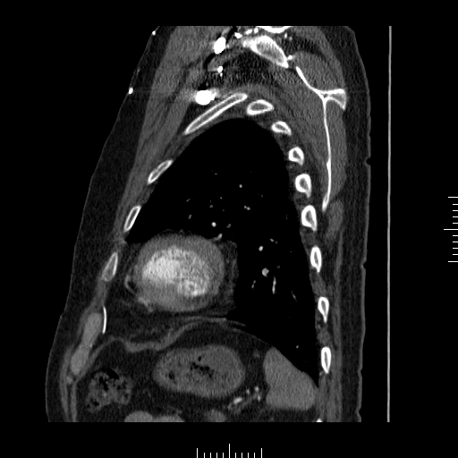 File:Aorto-coronary bypass graft aneurysms (Radiopaedia 40562-43157 C 35).png