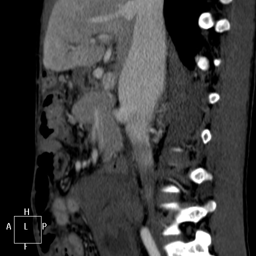 Aorto-left renal vein fistula (Radiopaedia 45534-49628 C 22).jpg