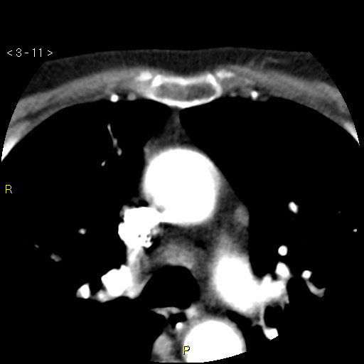 File:Aortoiliac occlusive disease (Radiopaedia 16828-16548 A 11).jpg