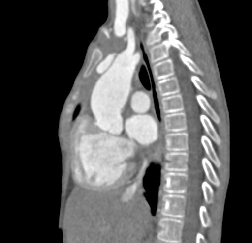 File:Aortopulmonary window, interrupted aortic arch and large PDA giving the descending aorta (Radiopaedia 35573-37074 C 15).jpg