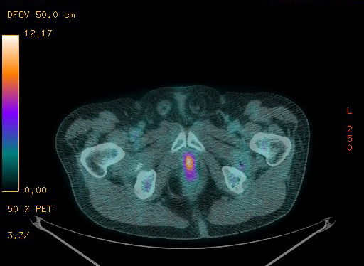 Appendiceal adenocarcinoma complicated by retroperitoneal abscess (Radiopaedia 58007-65041 Axial PET-CT 194).jpg