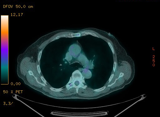 Appendiceal adenocarcinoma complicated by retroperitoneal abscess (Radiopaedia 58007-65041 Axial PET-CT 61).jpg