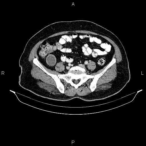 File:Appendiceal mucocele (Radiopaedia 82952-97298 B 76).jpg