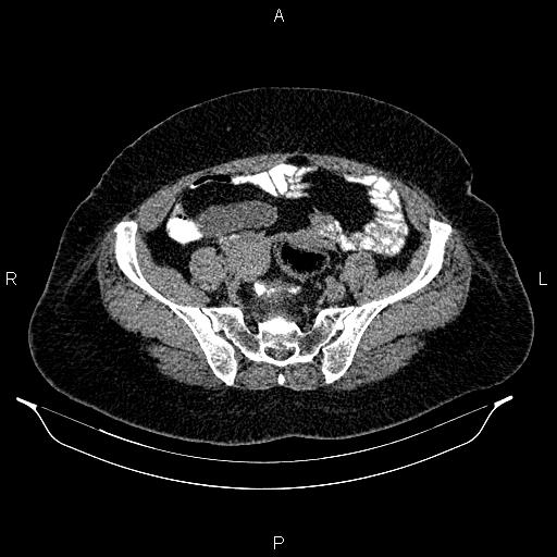 Appendiceal mucocele (Radiopaedia 86415-102460 Axial non-contrast 42).jpg