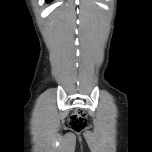 File:Appendicitis complicated by post-operative collection (Radiopaedia 35595-37113 B 48).jpg