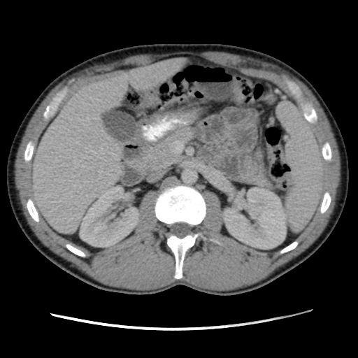 Appendicitis complicated by post-operative collection (Radiopaedia 35595-37114 A 31).jpg