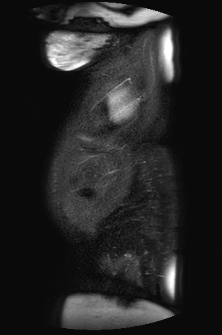 Appendicitis in gravida (MRI) (Radiopaedia 89433-106395 Sagittal T2 SPAIR 3).jpg