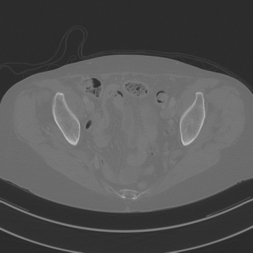 April fools' 2019- calcified peritoneal arachnoidosis (Radiopaedia 67273-76636 Axial bone window 47).png