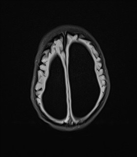 File:Aqueductal stenosis (Radiopaedia 73974-84802 Axial FLAIR 17).jpg
